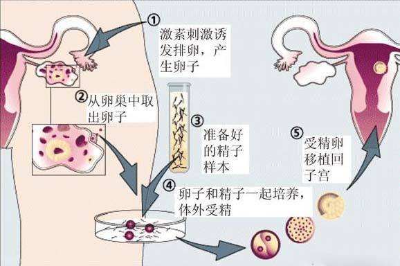 做赠卵助孕自怀机构可以有宫外孕吗？